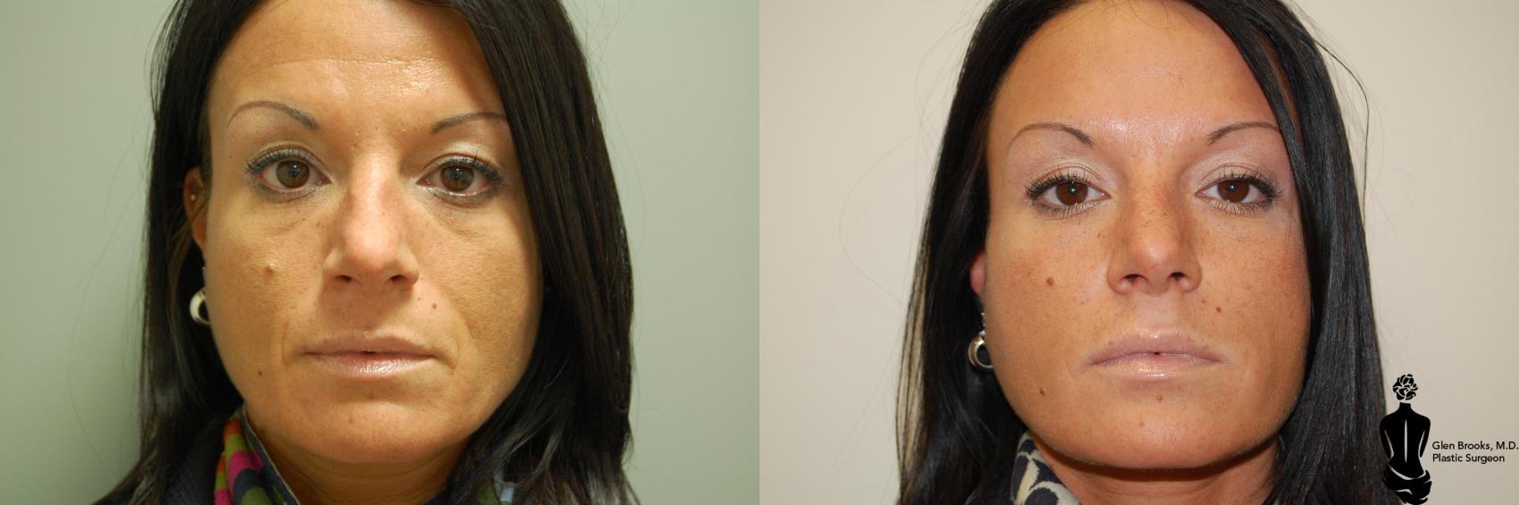 Before & After BOTOX Cosmetic Case 35 View #1 View in Springfield, MA