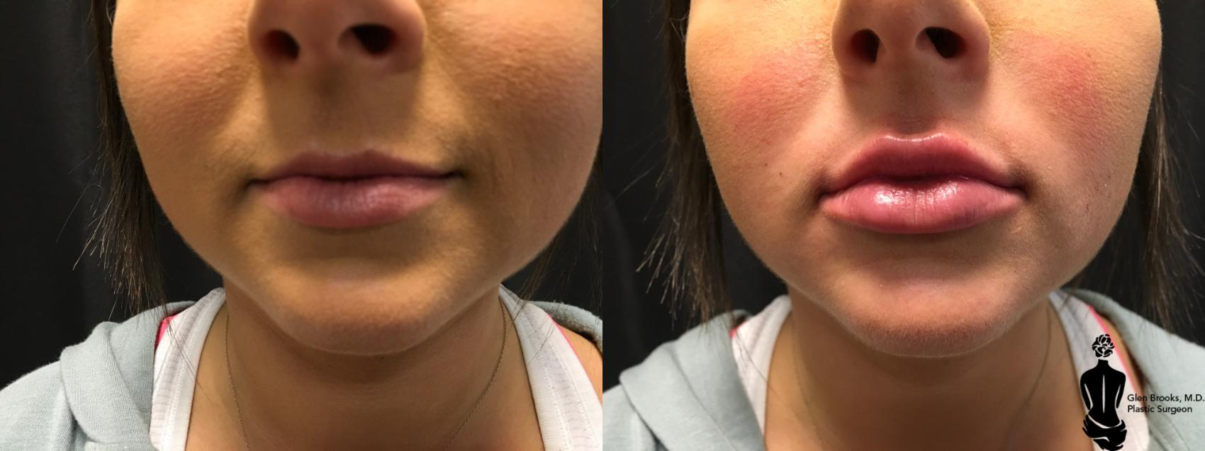 Before & After Fillers Case 148 View #1 View in Springfield, MA