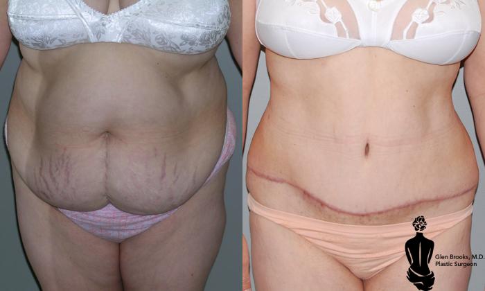 Before & After Abdominoplasty Case 1 View #1 View in Springfield, MA