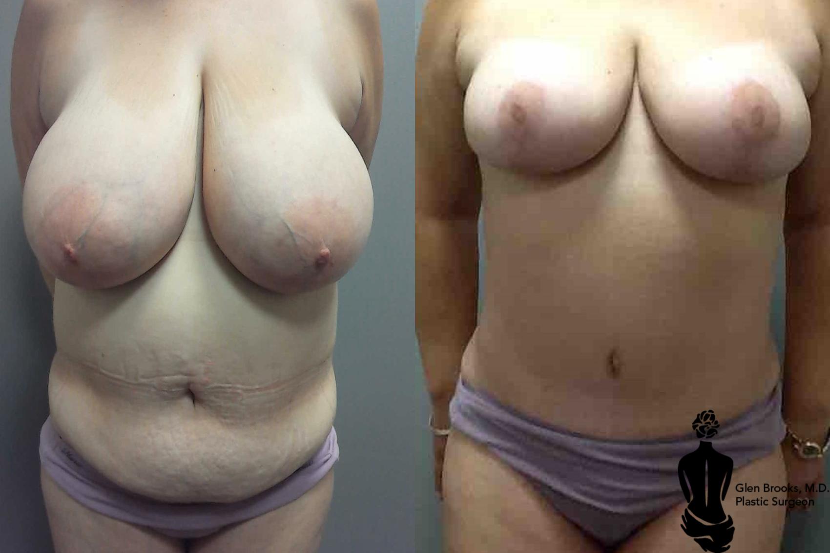 Before & After Abdominoplasty Case 102 View #1 View in Springfield, MA