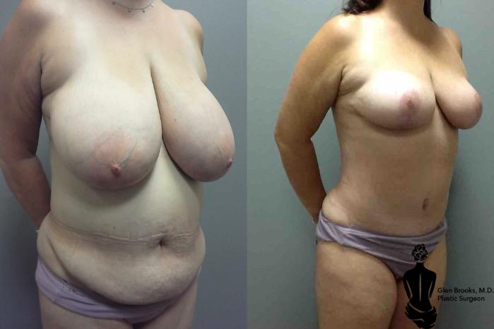Before & After Abdominoplasty Case 102 View #2 View in Springfield, MA