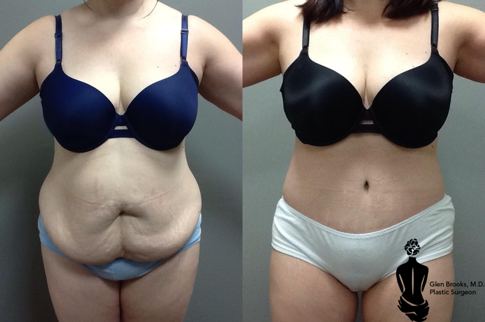 Before & After Abdominoplasty Case 103 View #1 View in Springfield, MA