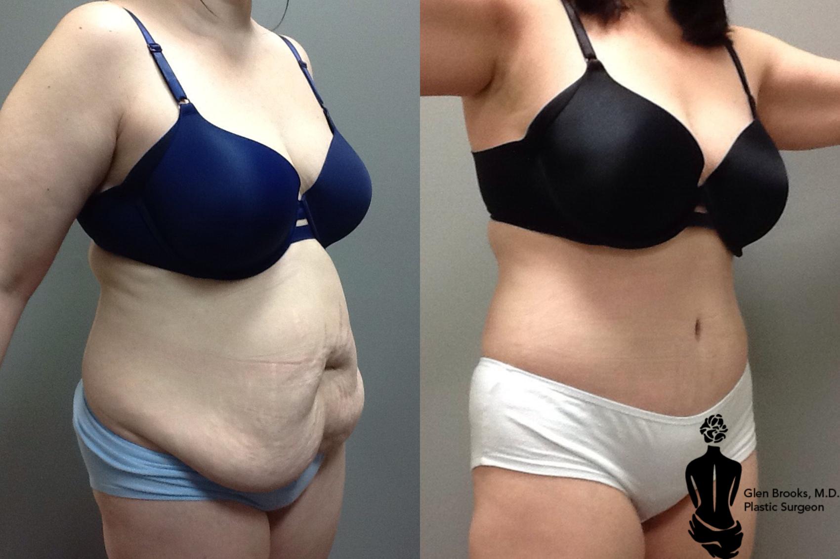 Before & After Abdominoplasty Case 103 View #2 View in Springfield, MA