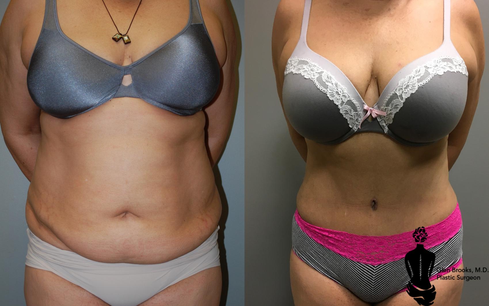 Before & After Abdominoplasty Case 105 View #1 View in Springfield, MA