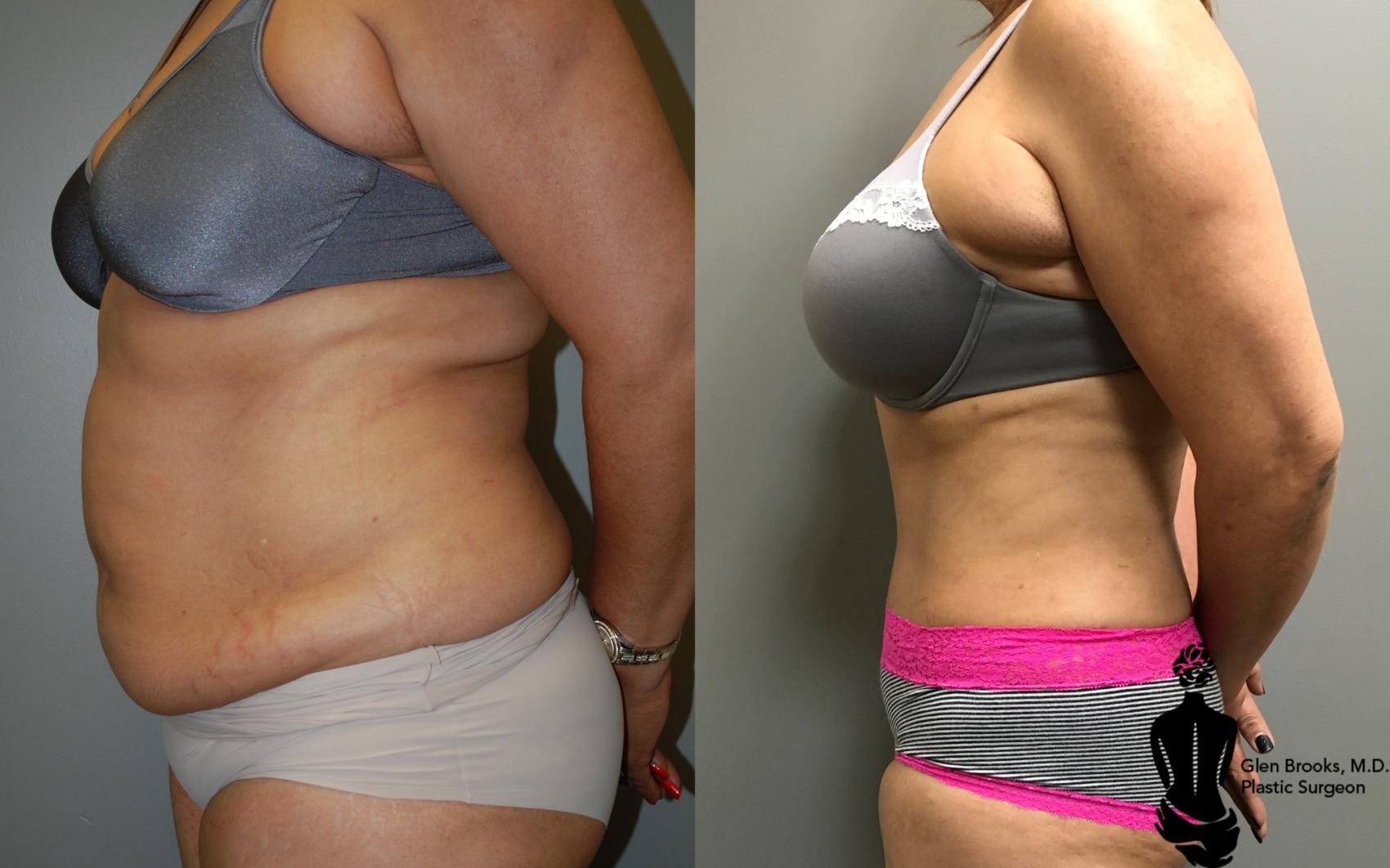 Before & After Abdominoplasty Case 105 View #2 View in Springfield, MA