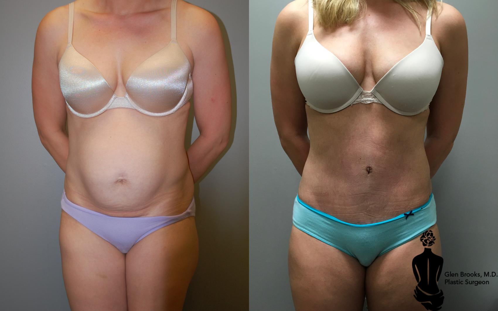 Before & After Abdominoplasty Case 121 View #1 View in Springfield, MA