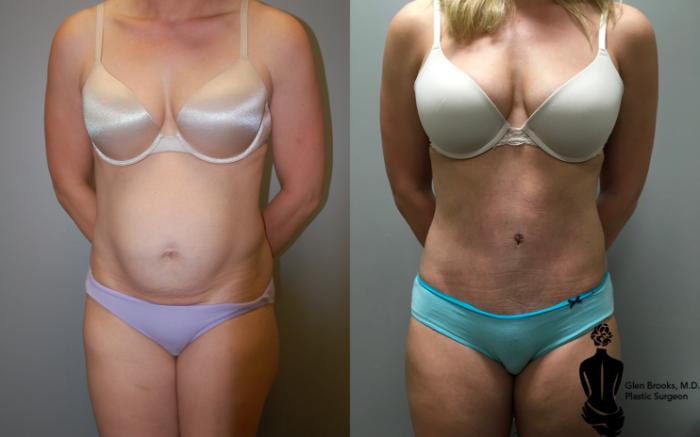 Before & After Abdominoplasty Case 121 View #1 View in Springfield, MA