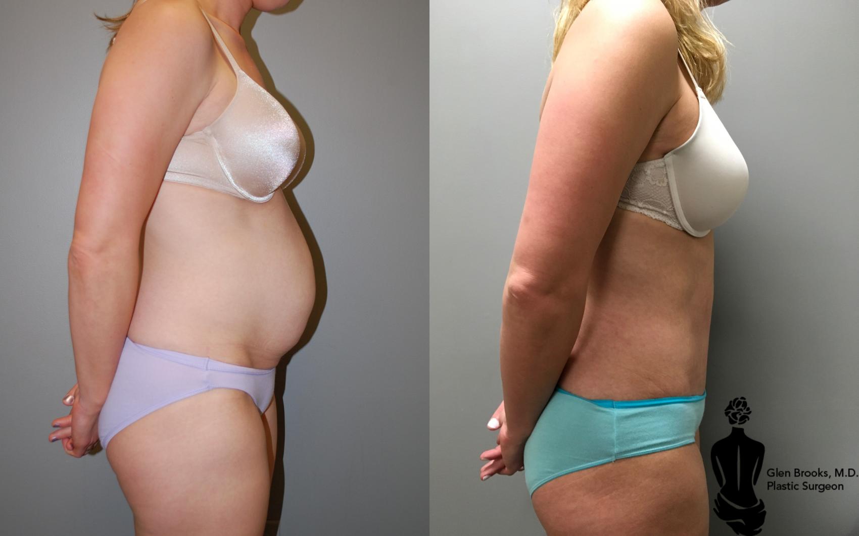 Before & After Abdominoplasty Case 121 View #2 View in Springfield, MA