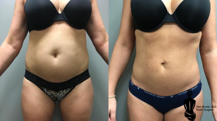 Before & After Abdominoplasty Case 147 View #1 View in Springfield, MA