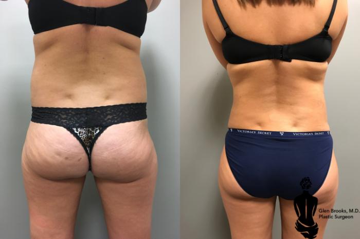 Before & After Abdominoplasty Case 147 View #2 View in Springfield, MA