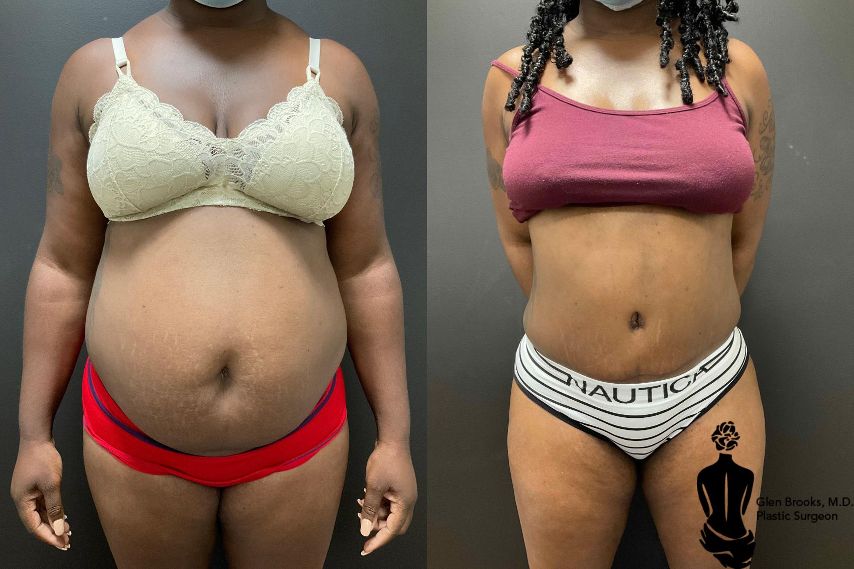 38 year old female from Springfield area, 5'4", 176 lbs.  Abdominoplasty with rectus diastasis repair to address mild excess skin of the lower abdomen and moderate amounts of excess fat of the upper and lower abdomen.
