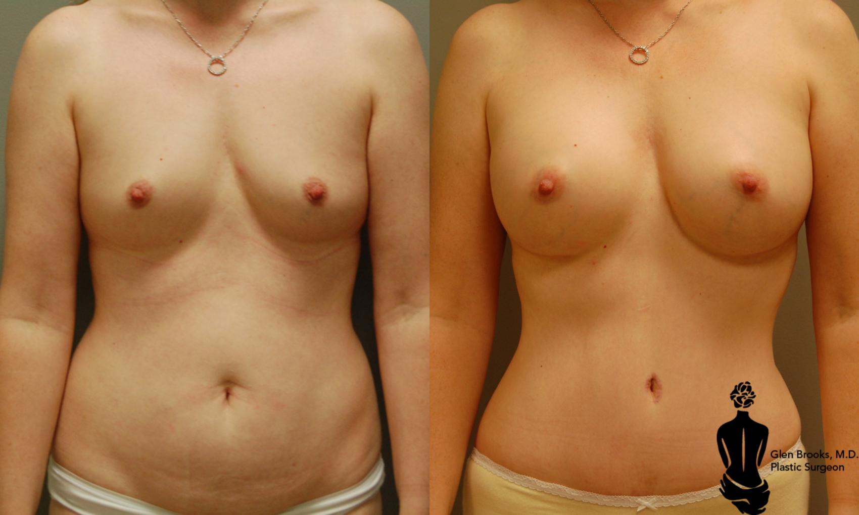 Before & After Abdominoplasty Case 17 View #1 View in Springfield, MA