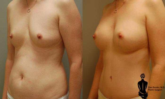 Before & After Abdominoplasty Case 17 View #2 View in Springfield, MA