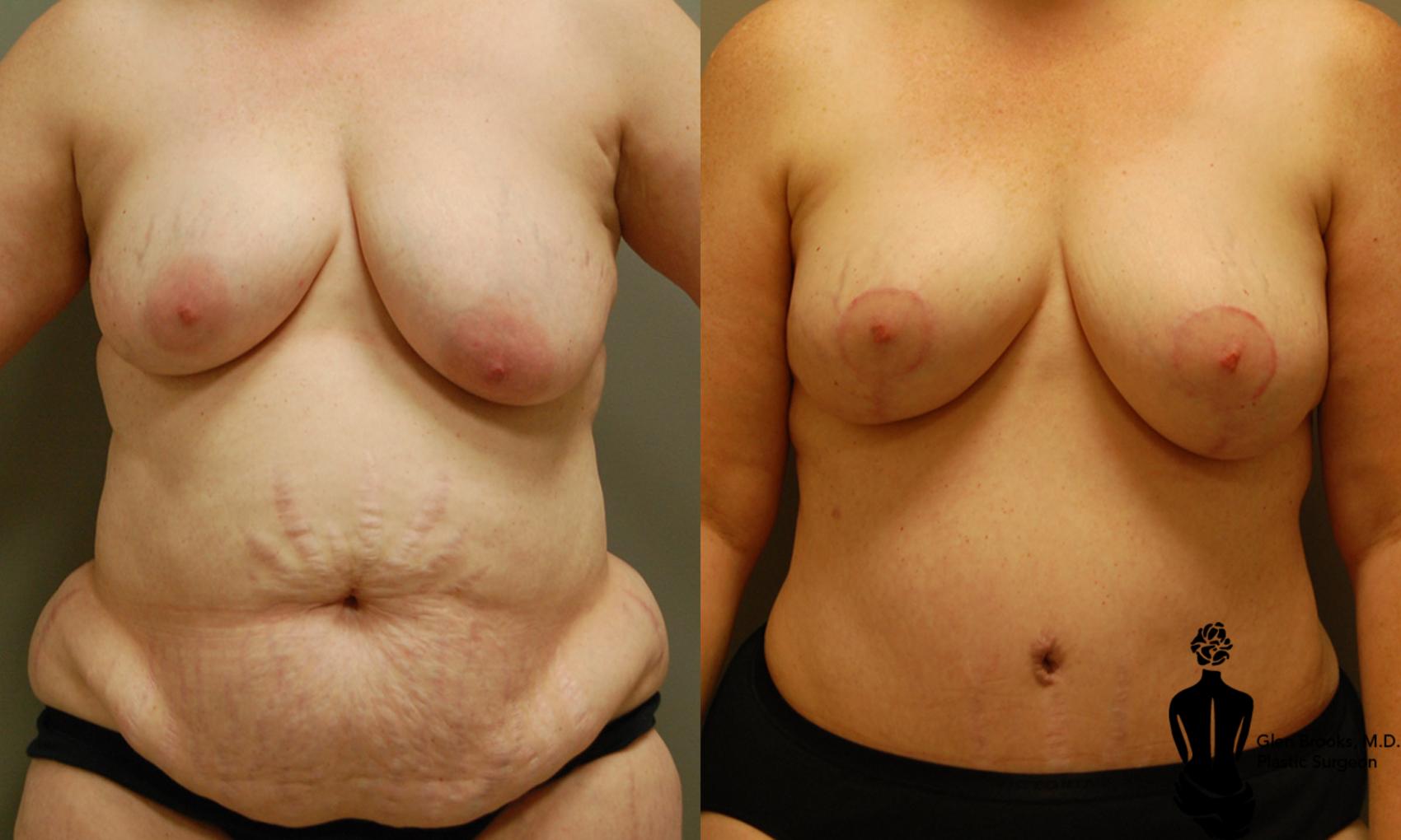 Before & After Abdominoplasty Case 18 View #1 View in Springfield, MA