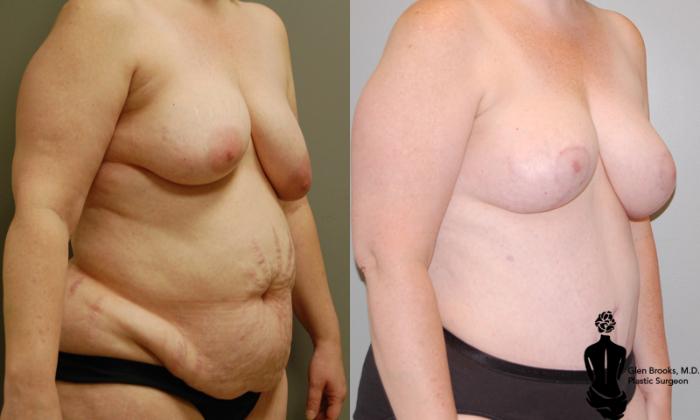 Before & After Abdominoplasty Case 18 View #2 View in Springfield, MA
