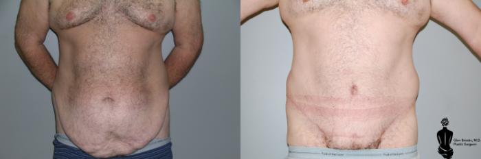 Before & After Abdominoplasty Case 28 View #1 View in Springfield, MA