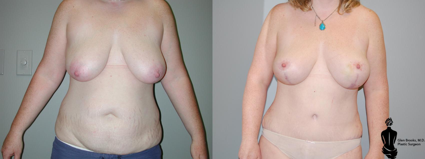 Before & After Abdominoplasty Case 29 View #2 View in Springfield, MA