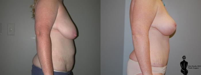 Before & After Abdominoplasty Case 29 View #4 View in Springfield, MA