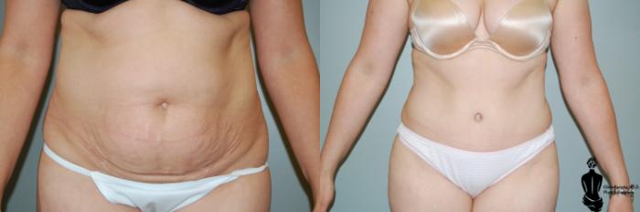 Before & After Abdominoplasty Case 33 View #1 View in Springfield, MA
