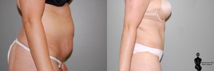 Before & After Abdominoplasty Case 33 View #2 View in Springfield, MA