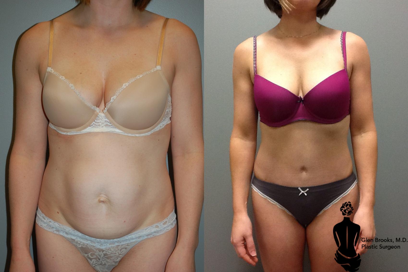 Before & After Abdominoplasty Case 40 View #2 View in Springfield, MA