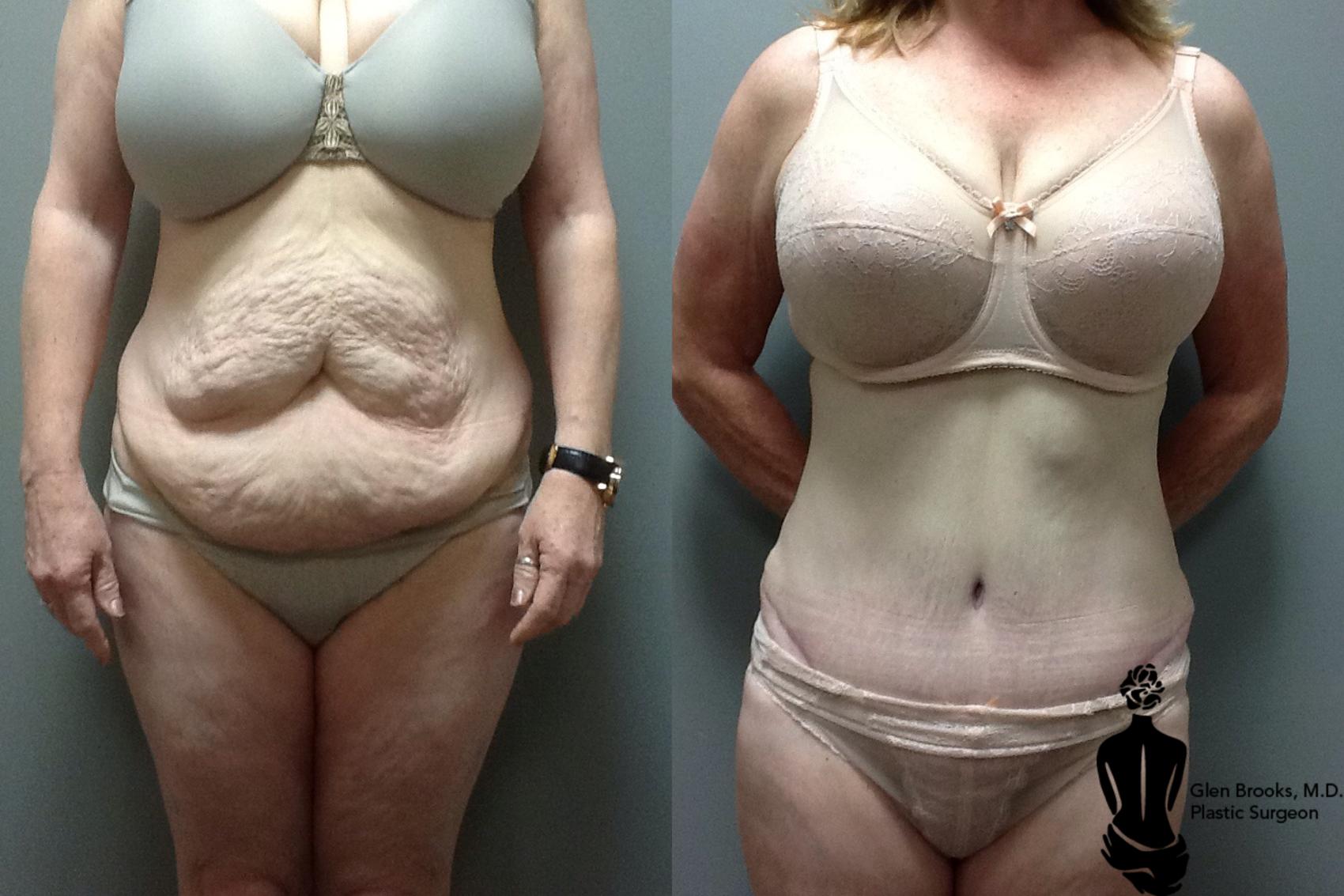 Before & After Abdominoplasty Case 41 View #1 View in Springfield, MA