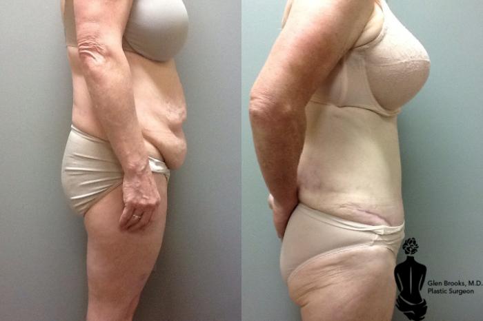 Before & After Abdominoplasty Case 41 View #2 View in Springfield, MA