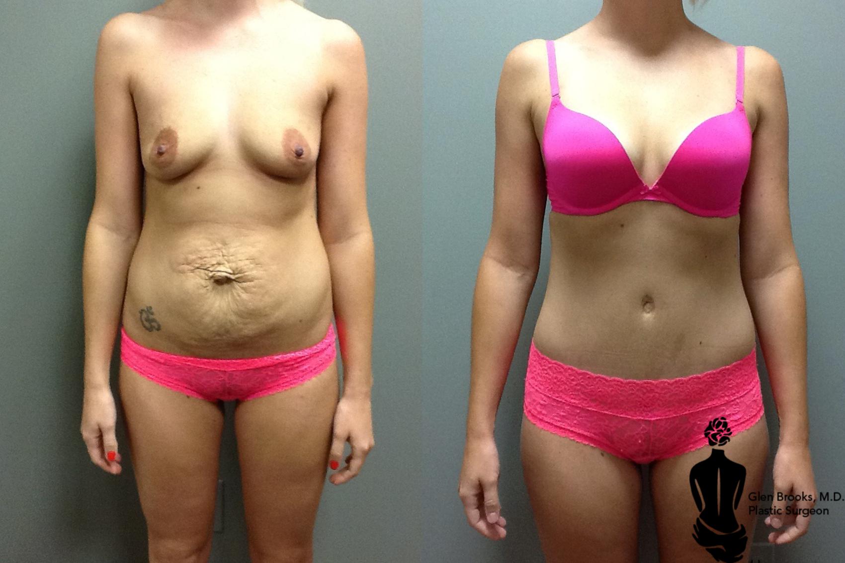 Before & After Abdominoplasty Case 42 View #1 View in Springfield, MA