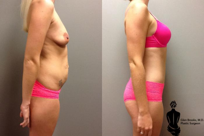 Before & After Abdominoplasty Case 42 View #2 View in Springfield, MA