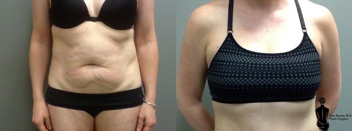 Before & After Abdominoplasty Case 43 View #1 View in Springfield, MA