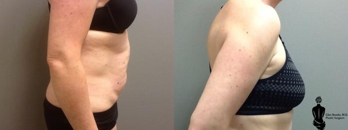 Before & After Abdominoplasty Case 43 View #2 View in Springfield, MA