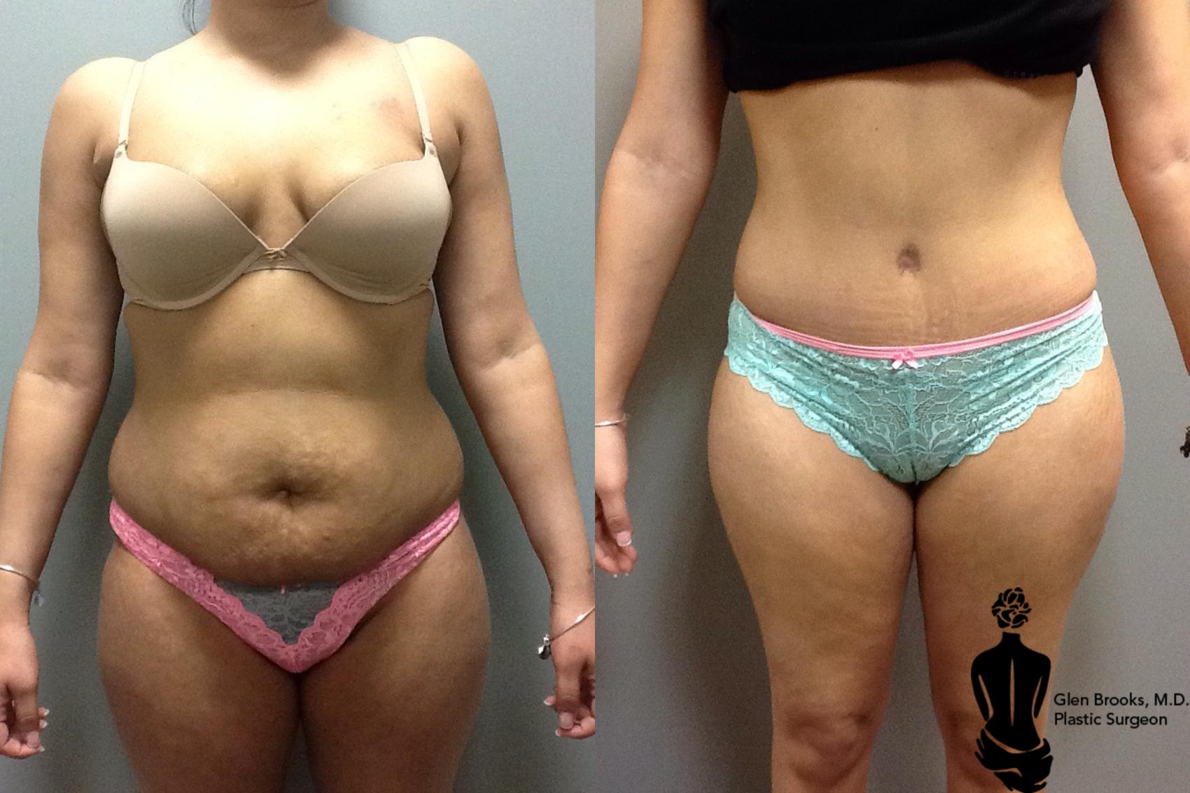 Before & After Abdominoplasty Case 59 View #1 View in Springfield, MA