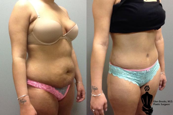 Before & After Abdominoplasty Case 59 View #2 View in Springfield, MA