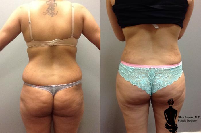 Before & After Abdominoplasty Case 59 View #3 View in Springfield, MA