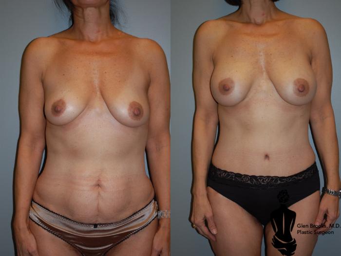 Before & After Abdominoplasty Case 72 View #1 View in Springfield, MA