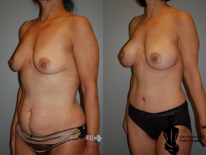 Before & After Abdominoplasty Case 72 View #2 View in Springfield, MA