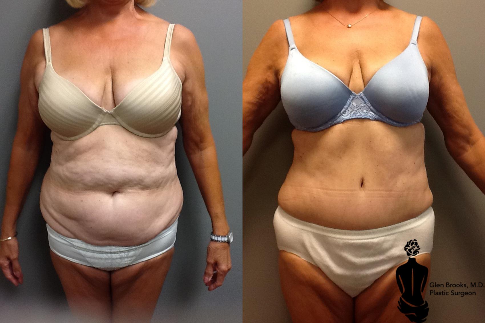 Before & After Abdominoplasty Case 73 View #1 View in Springfield, MA