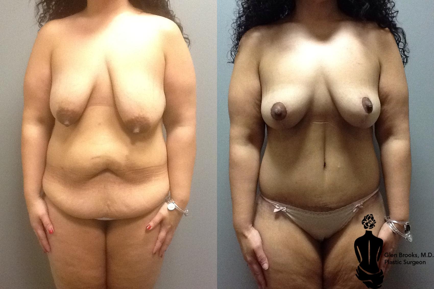 Before & After Abdominoplasty Case 83 View #1 View in Springfield, MA