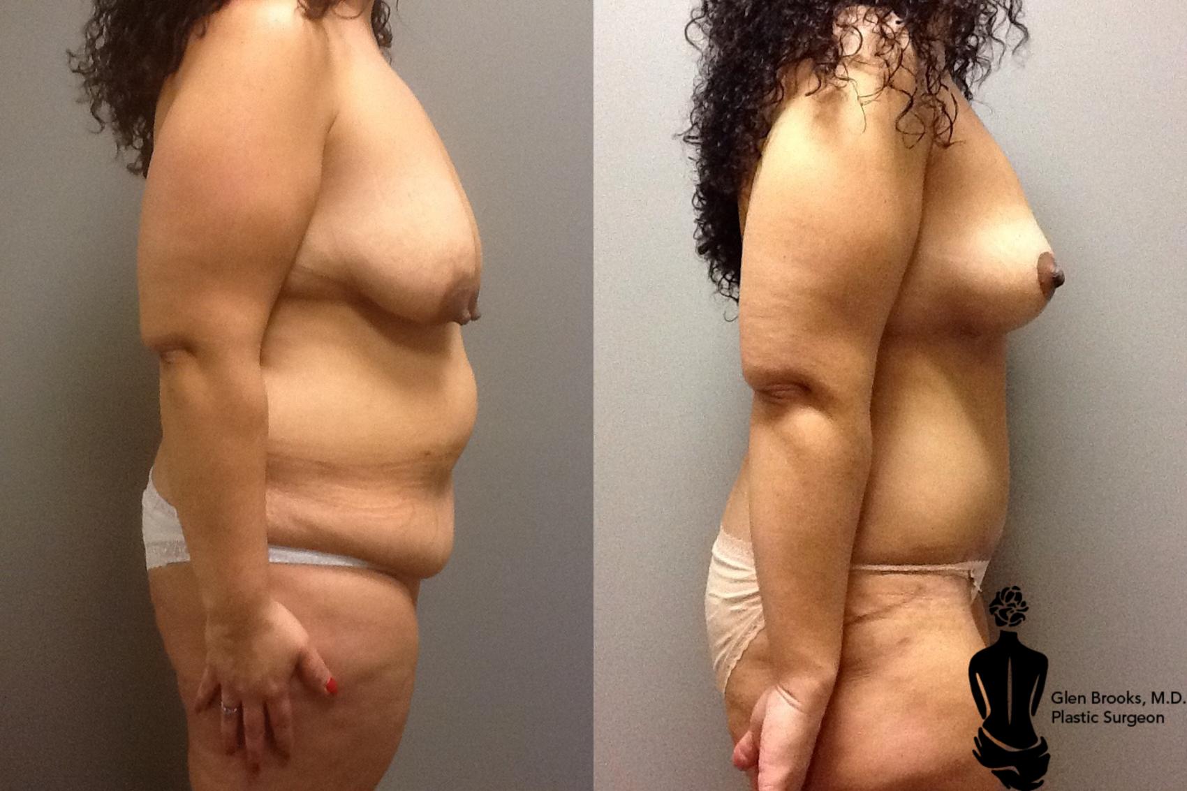 Before & After Abdominoplasty Case 83 View #2 View in Springfield, MA