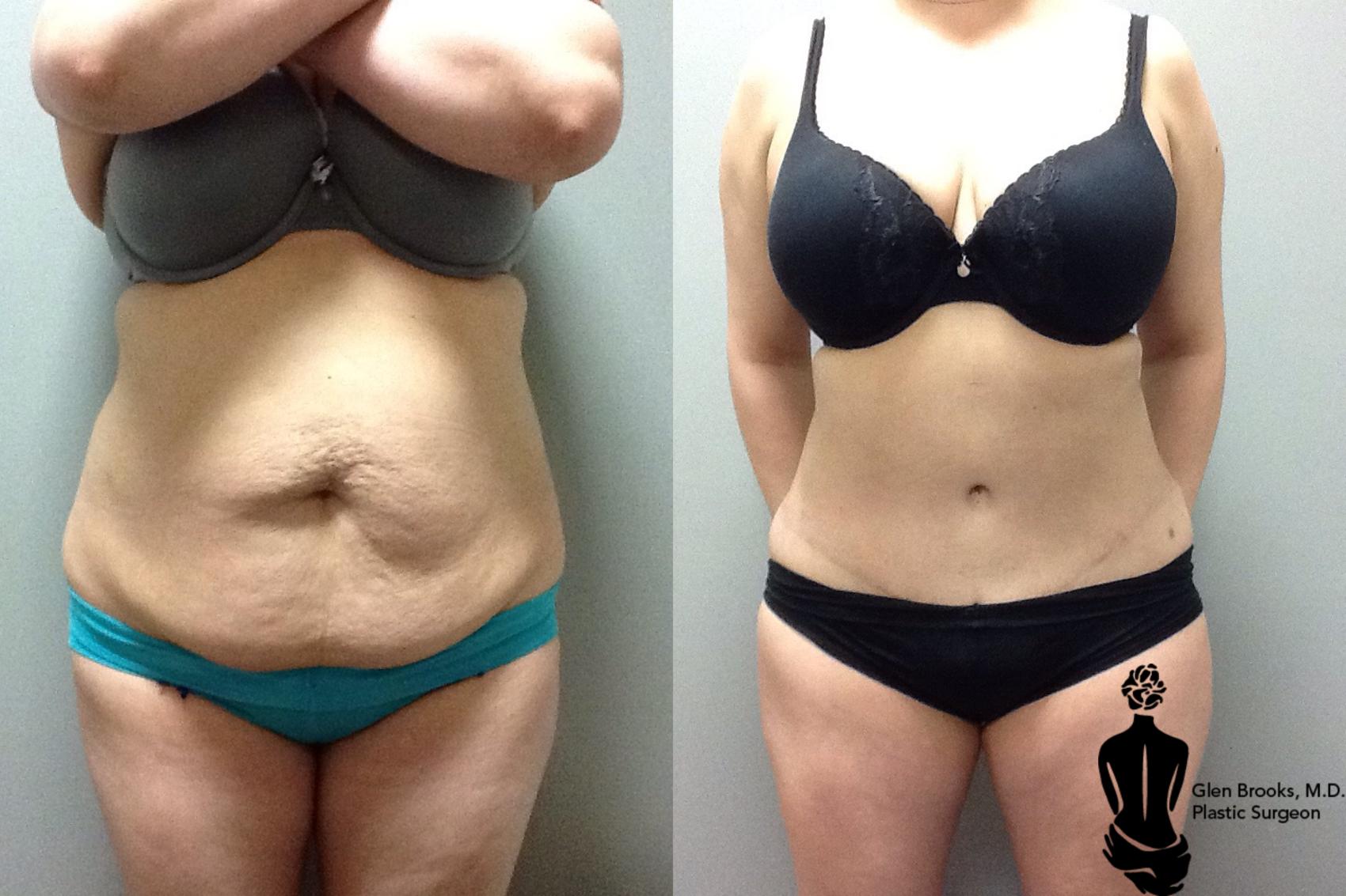 Before & After Abdominoplasty Case 97 View #1 View in Springfield, MA