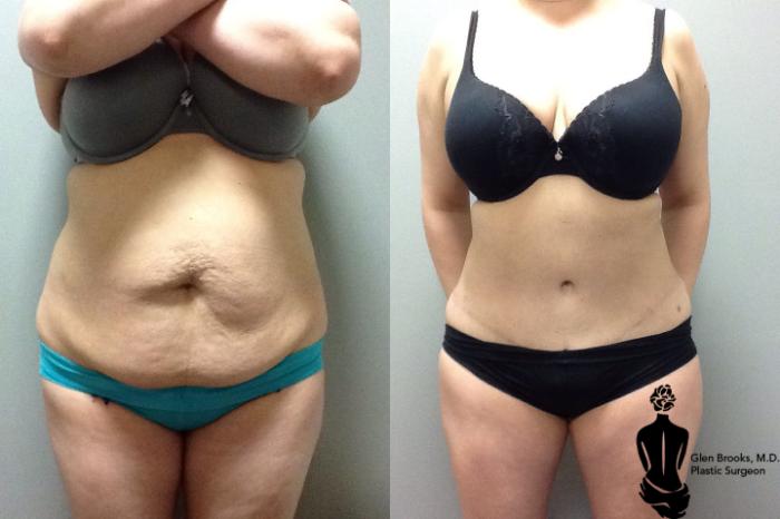 Before & After Abdominoplasty Case 97 View #1 View in Springfield, MA