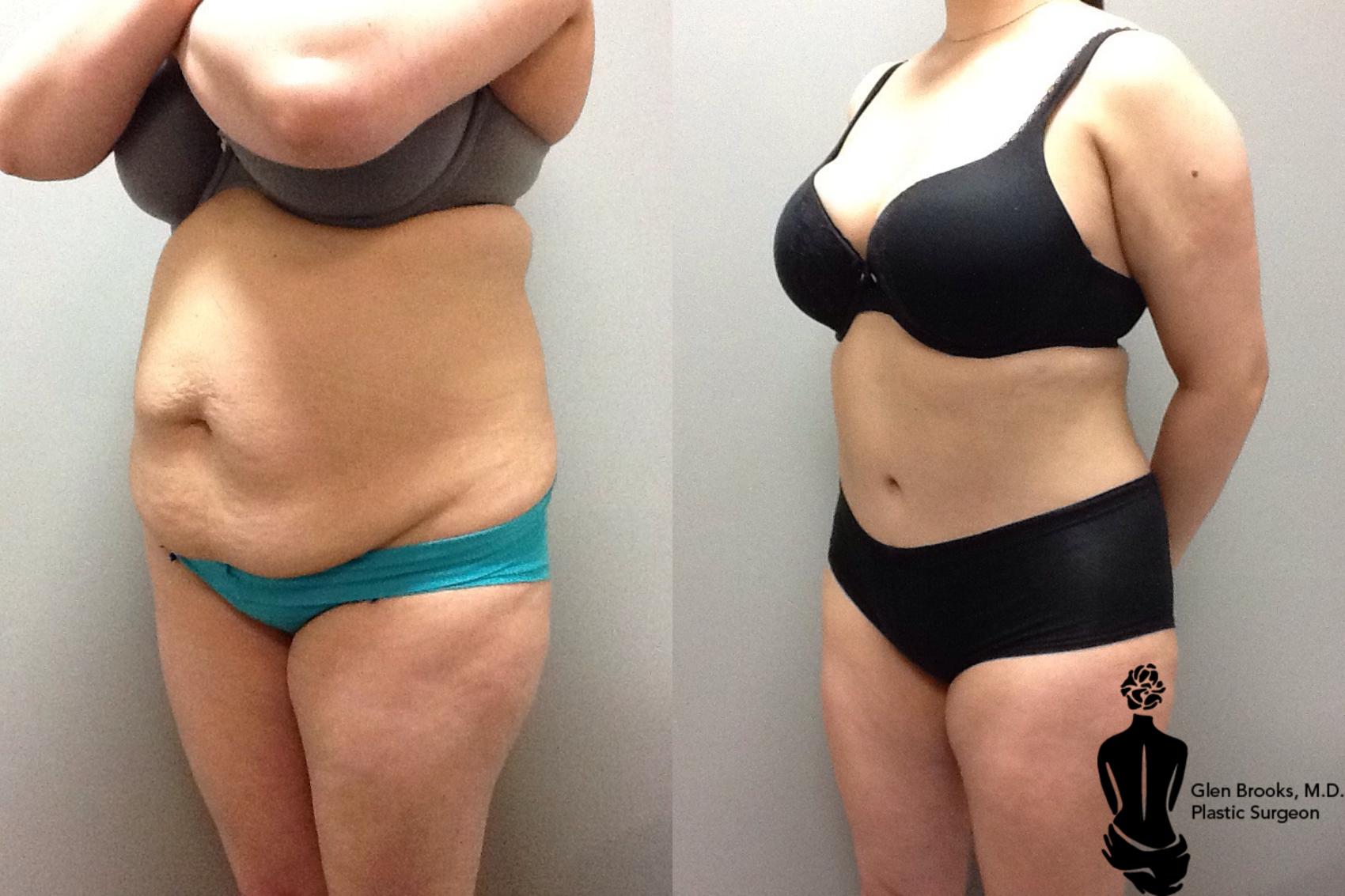Before & After Abdominoplasty Case 97 View #2 View in Springfield, MA