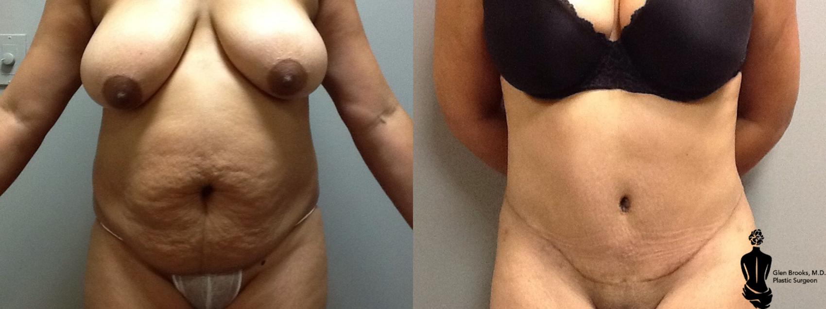 Before & After Abdominoplasty Case 98 View #2 View in Springfield, MA