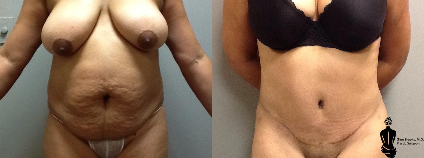 Tummy Tuck in Chelmsford - Plastic Surgery Chelmsford, MA