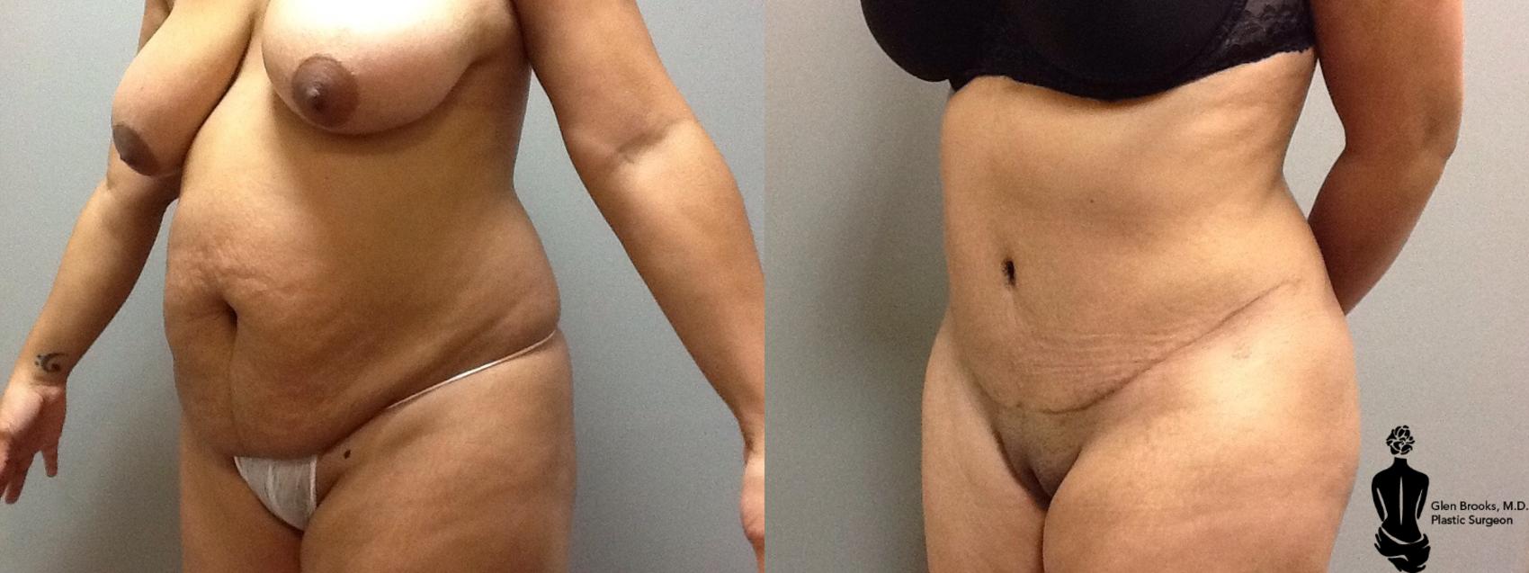 Before & After Abdominoplasty Case 98 View #4 View in Springfield, MA