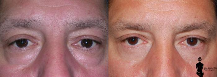 Before & After Blepharoplasty Case 10 View #1 View in Springfield, MA