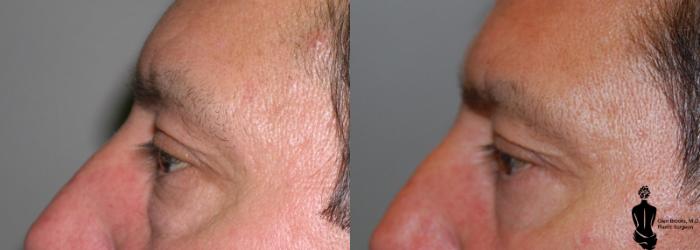 Before & After Blepharoplasty Case 10 View #2 View in Springfield, MA