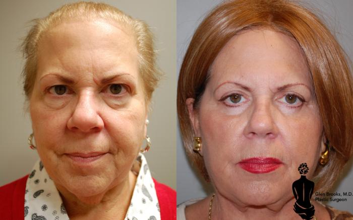 Before & After Blepharoplasty Case 104 View #1 View in Springfield, MA