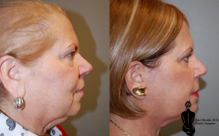 Before & After Blepharoplasty Case 104 View #2 View in Springfield, MA