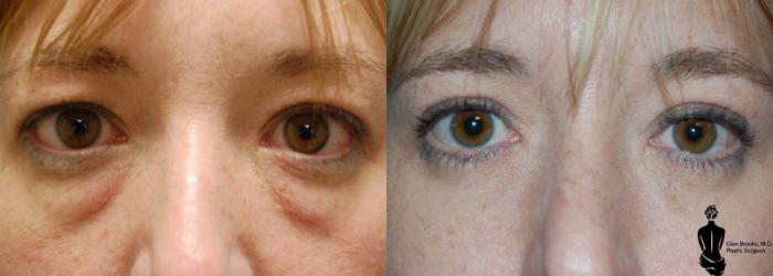 Before & After Blepharoplasty Case 11 View #1 View in Springfield, MA